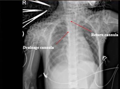 Fulminant myocarditis associated with human rhinovirus A66 infection: a case report